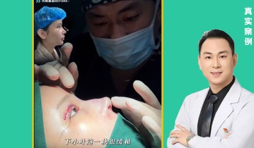 直鼻改华丽微驼峰鼻术后案例