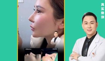3D建模灵动鼻术后10天效果案例