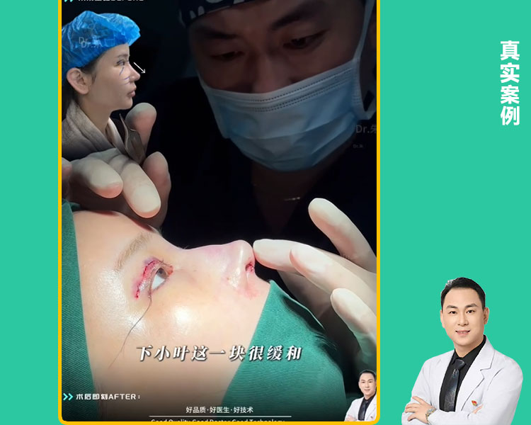 直鼻改华丽微驼峰鼻术后案例