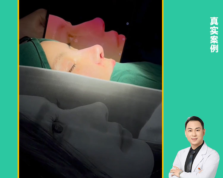 朱萌院长微驼峰案例分享：打造专属自然美鼻